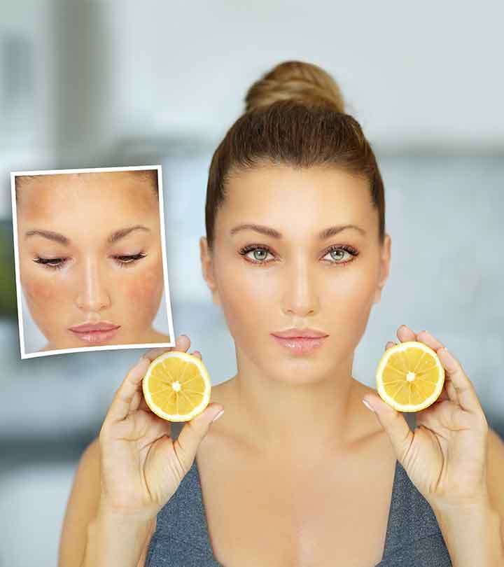 9-Home-Remedies-To-Remove-Dark-Spots-On-Face-With-Lemon-Juice